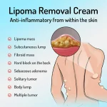 Lipoma Removal Cream | South Moon Lipoma Treatment Ointment