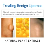 Lipoma Removal Cream | South Moon Lipoma Treatment Ointment - Image 6